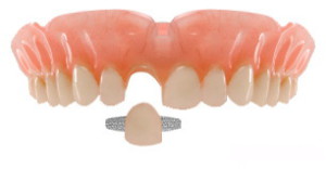 Адгезивные зубные протезы
