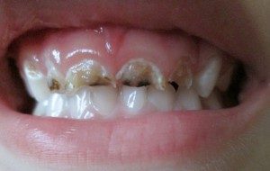 Почему крошатся зубы