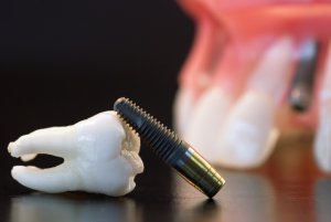 istoriya-razvitiya-zubnoj-implantatsii