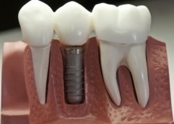 Противопоказания к проведению зубной имплантации