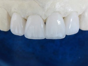 Циркониевые зубные коронки