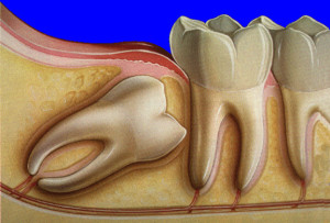 Ретинированные зубы