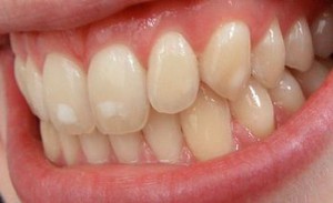 флюороз зубов