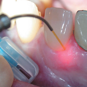 лазерная стоматология Сумы
