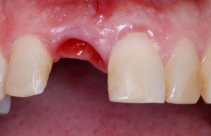 дырка в десне после удаления зуба