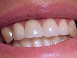 Реставрация зубов (Сумы)