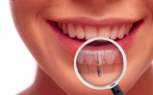Зубная имплантация в Сумах