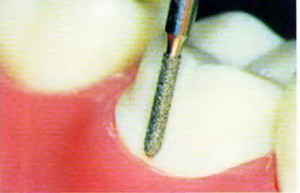 Обточка зубов