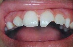перелом зуба