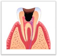 Болезни зубов пульпит
