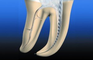 Лечение каналов зуба Сумы