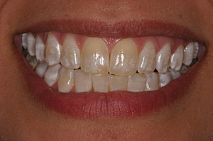 Деминерализация зубов