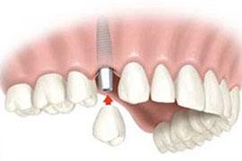 Имплантация зубов в Сумах