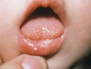 Виды афтозного стоматита у детей