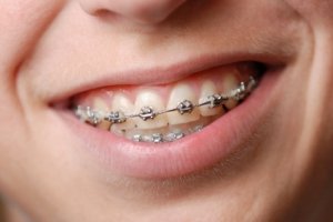 Установить металлические брекеты в Сумах