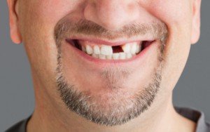 преждевременная потеря зуба