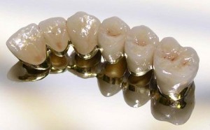 Зубная коронка из металлокерамики