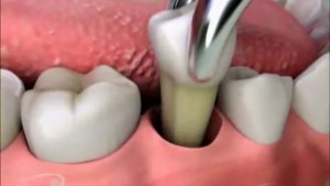 удаление зуба Сумы