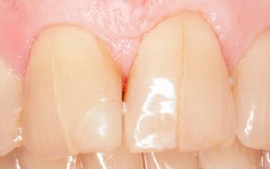 трещины на зубах