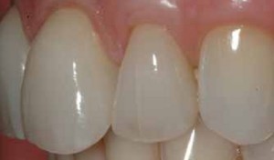 Трещины на зубах лечение