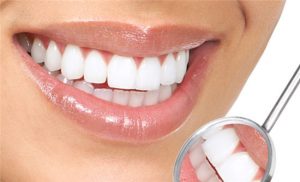 Зубные виниры в стоматологии