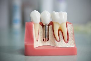 Про экспресс имплантацию зубов