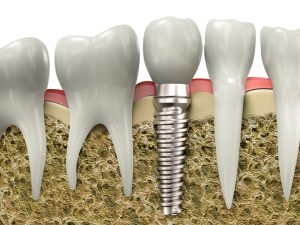 Восстановление утраченных зубов при имплантации