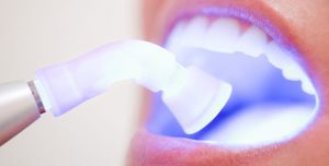 Пять фактов о лазерном отбеливании зубов