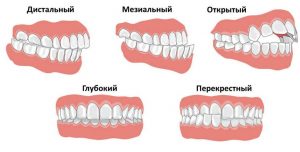 Неправильный прикус - не только проблема эстетики