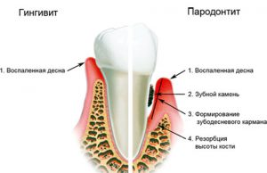 Про пародонтит