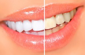 Что влияет на цвет зубной эмали?