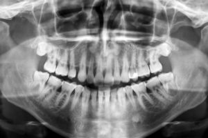 Панорамный снимок зубов