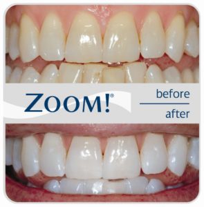 Отбеливание зубов Zoom 3