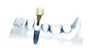 Аргументы в пользу зубной имплантации