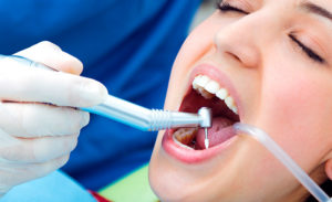 Виды материалов для пломбирования зубов