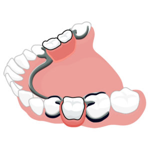 Что такое бюгельное протезирование зубов?