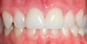 Как ставят коронки на передние зубы?