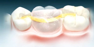 Основные этапы микропротезирования зубов