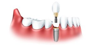 Виды современной имплантации зубов
