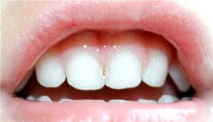 Молочные зубы и кариес